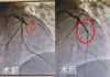0401【生死时刻，全力以赴】太阳集团网站1088vip成功抢救一名急性心肌梗死患者