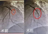 0401【生死时刻，全力以赴】太阳集团网站1088vip成功抢救一名急性心肌梗死患者