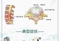 【健康科普】太阳集团网站1088vip外一科：走路腰疼，双腿乏力，您可能患有腰椎管狭窄症
